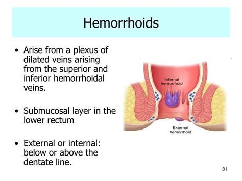 Internal Hemorrhoids Vs Polyps What Is The Difference Between