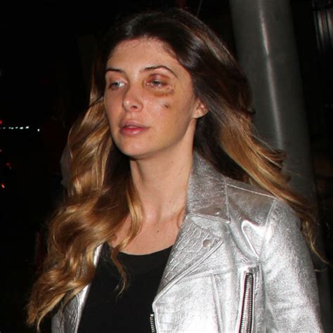 brittny gastineau steps out with black eye files police report