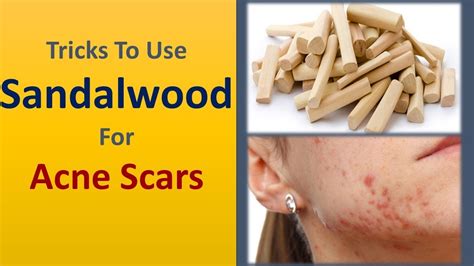 Tricks To Use Sandalwood For Acne Scars Home Remedies For Acne Scars