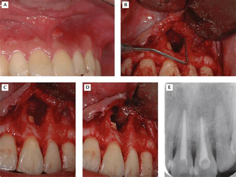 A Persistent Sinus Tract Over Tooth 21 After Endodontic Retreatment