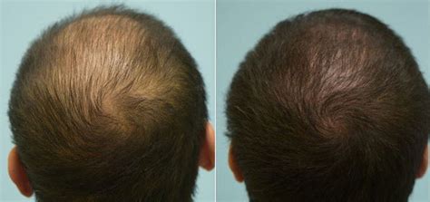 Finasteride Before And After Photos 2022