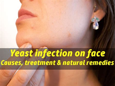 Yeast Infection On Face Learn What Causes Yeast Infection On Face And