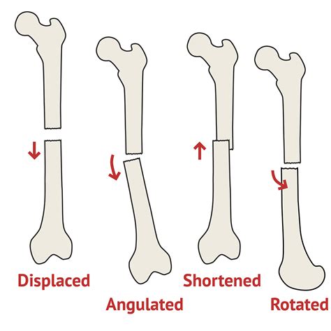 What Are The Four Types Of Fractures Mapametawan