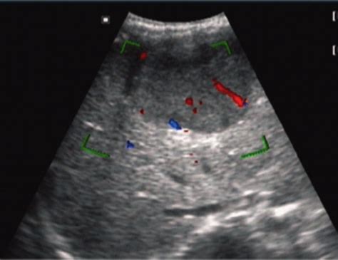 Abdominal Ultrasound Hepatic Tumor With Vascularisation Download