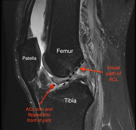 Torn Acl Symptoms And Diagnosis Video Jeffrey H Berg Md