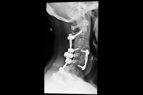 Life After Three Level Posterior Cervical Fusion Surgery Mila Hathaway