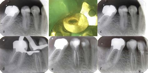 A Preoperative Radiograph Of Three Rooted Second Mandibular Premolar