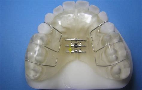 Twin Block Accutech Orthodontic Laboratory Products