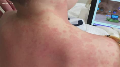 How To Spot Rare Inflammatory Syndrome Affecting Children With
