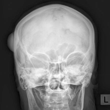Skull Vault Osteoma Radiology Reference Article Radiopaedia Org