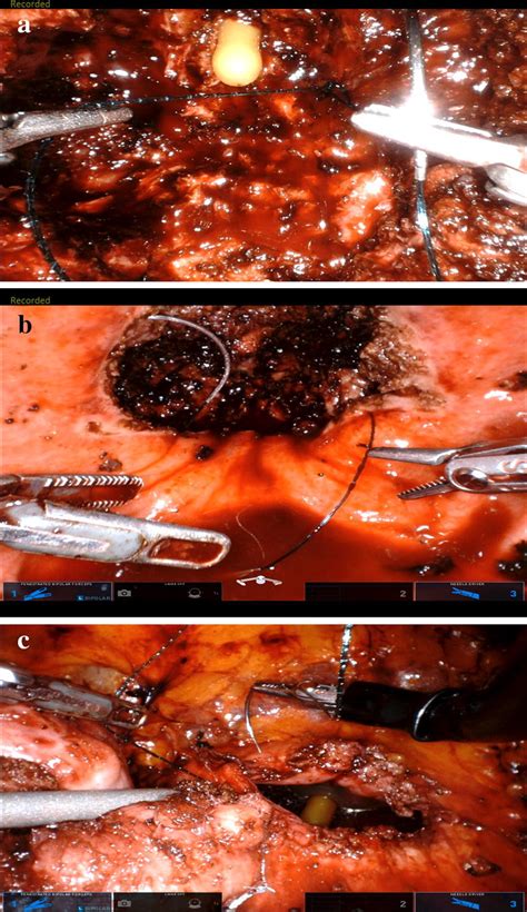 Reconstructive Steps Of A Robotic Simple Prostatectomy Using The Da Download Scientific Diagram