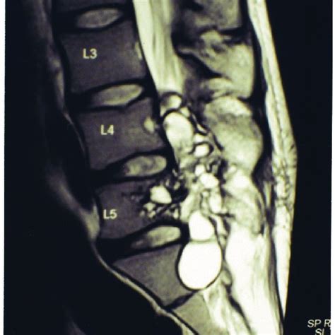 Sagittal T2wi Mri Scan Of The Lumbo Sacral Spine Showing Multiple Cysts