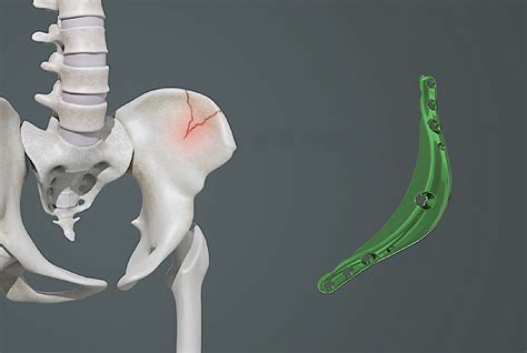 Hip Widening By Iliac Crest Bone Implant Augmentation Concept And
