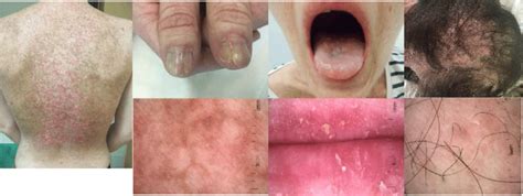 Chronic Graft Vs Host Disease Manifestations In Patient Involving Skin