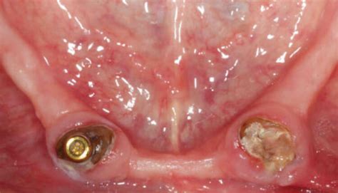 Impact Of Keratinized Mucosa In Dental Implant Treatment Decisions In