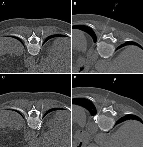 Ct Guidance For Correct Positioning Of The Needle During The