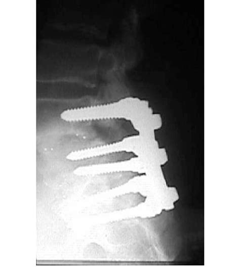 Posterior Lumbar Interbody Fusion This Shows L4 L5 And L5 S1