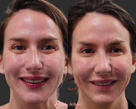 Botox Injections Before And After Photos