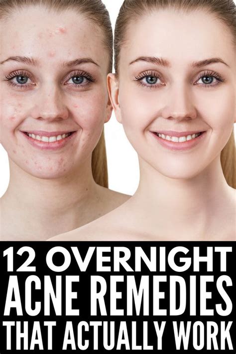 Learn 3 ways from bustle featuring skin care expert jolie martin of skinney medspa, voted the best spa nyc. How to Get Rid of Acne Overnight: 12 Remedies that Work ...