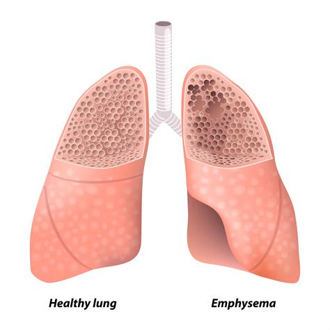 Emphysème Pulmonaire Causes Symptômes Et Moyens De Traitement