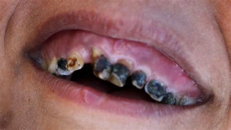 Comment Would Pictures Of Rotten Teeth On Sugary Drinks Put You Off