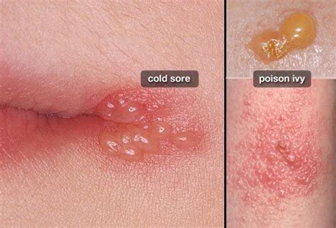 So here are pics of what is apparently a pretty textbook outbreak. Pin on Healthy Living
