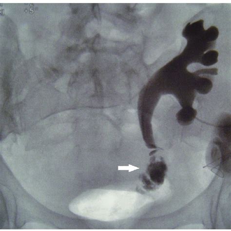 Nephrostogram Demonstrating Urinary Leakage At The Site Of The Ureteral Download Scientific