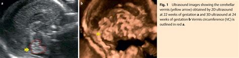 Figure 1 From Fetal Cerebellar Vermis Circumference Measured By 2