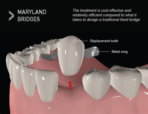 What Are The Differences Between Dental Implants And Bridges Smilex
