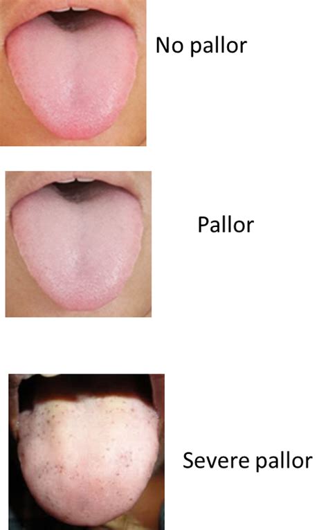 Pallor And Its Grading Psm Made Easy