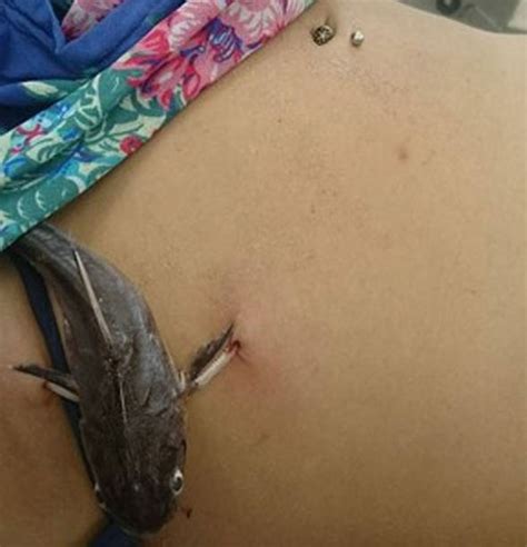 Woman Rushed To Hospital After Catfish Attaches Itself To