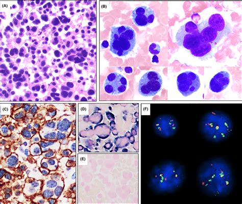 Bone Marrow Evaluation Showed Sheets Of Neoplastic Cells With Many
