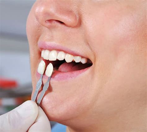 Lentes De Contato Dentais Quais São As Etapas Do Tratamento