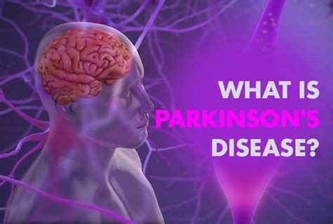Parkinsons Disease Is A Serious Brain Disorder Is There Any Cure All Faqs Answered By Expert