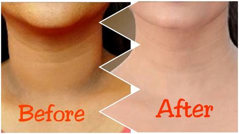 How To Get Rid Of Dark Neck In 15 Minutes Fast And Quickly Youtube
