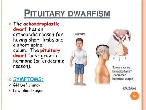 Hypopituitary Dwarfism Vs Achondroplasia