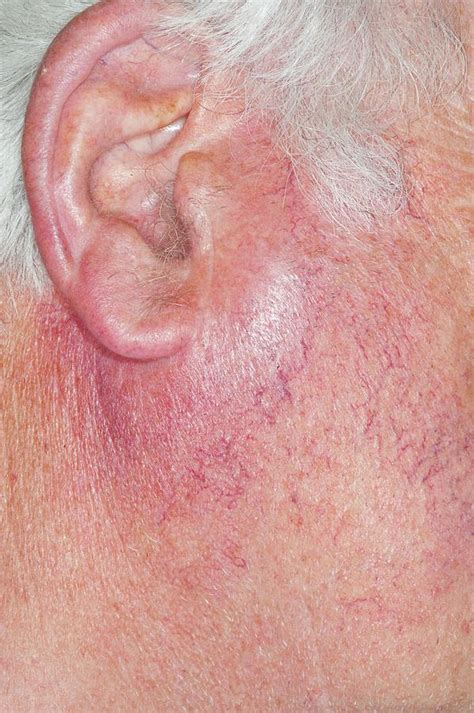 Parotid Gland Enlargement Photograph By Dr P Marazziscience Photo Library