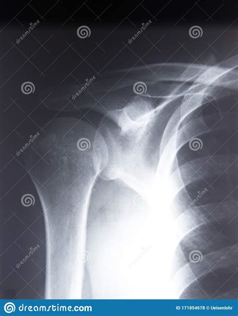 Radiography Of The Shoulder Joint And Ribs In Direct Projection With A