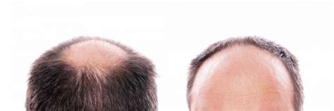 Alopecia Androgenetica Cosè E Quali Sono I Sintomi E Come Si
