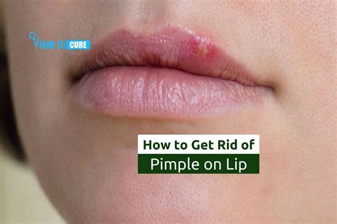 7 Easy And Simple Home Remedies On How To Get Rid Of Pimple On Lip