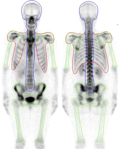 Computer Assisted Interpretation Of Planar Whole Body Bone Scans
