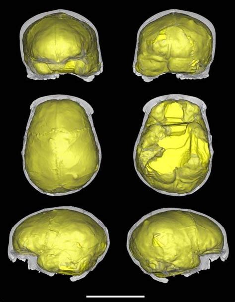 Craniosynostosis In The Middle Pleistocene Human Cranium 14 From The