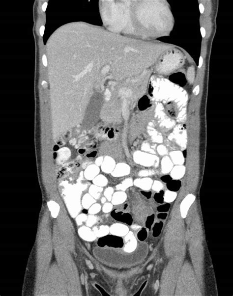 Ct Abdomen And Pelvis With Contrast Thaipolicepluscom