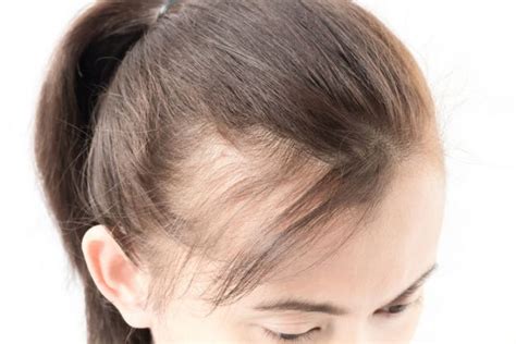 Androgenic alopecia, also known as male pattern baldness, comes from the shrinkage of hair follicles. Managing PCOS Associated Hair Loss | Vancouver Naturopath