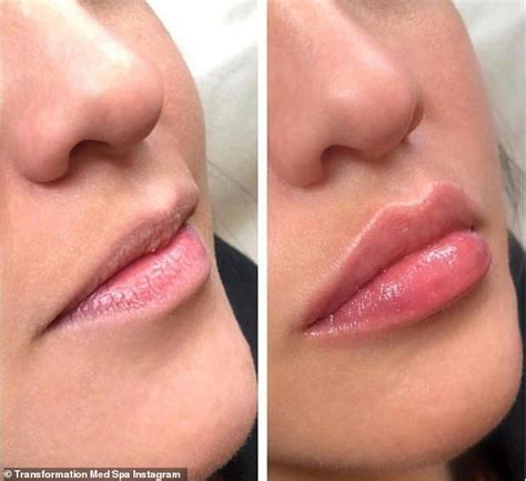 Pin By Noor On Face Botox Lips Lip Fillers Perfect Lips