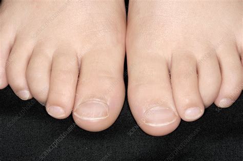 Curly Toes Stock Image C002 4864 Science Photo Library