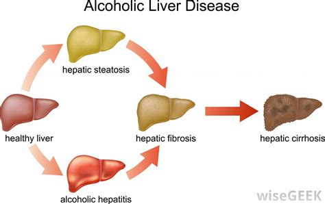 Diagram of the liver liver directed therapies for primarymetastatic hepatic malignancies clancy clark md. What is a Vein Bypass? (with pictures)
