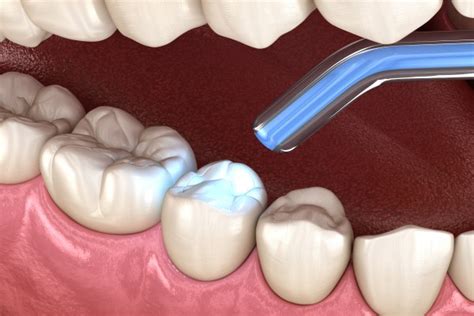 How A Dental Filling Is Used To Treat A Cavity Shawna Omid Dds