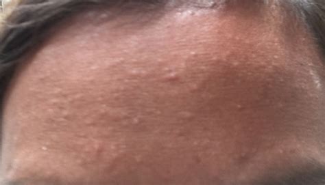 Small Bumps On Forehead General Acne Discussion Community