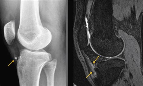 Osgood Schlatters Disease Radiology Q Radiology